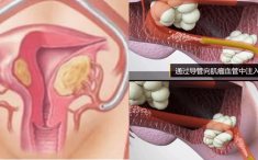 重庆大学附属肿瘤医院血管与介入科开展子宫动脉介入栓塞术治疗子宫肌瘤