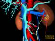 “内藏杀机”—完全内生型肾肿瘤 之精准切除